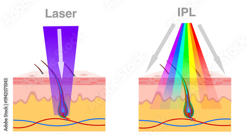 IPL, laser epilation, differences between. Hair intense pulsed light, removal exposure pulses. Permanent solution. Skin layers, anatomy. Cosmetic, medical device. Illustration vector