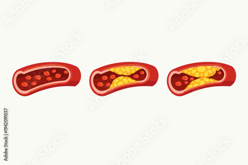 Medical vector illustration showing three stages of atherosclerosis in a coronary artery, from a healthy vessel to plaque buildup and severe narrowing, representing heart disease and cholesterol.
