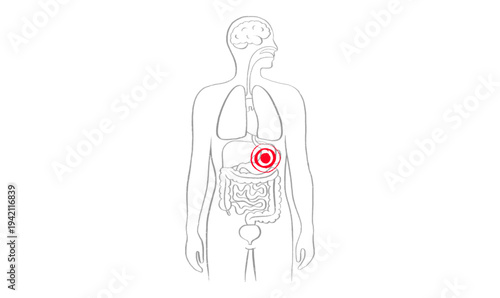 Gastroesophageal reflux pain