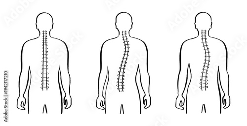 Scoliosis spine deformity