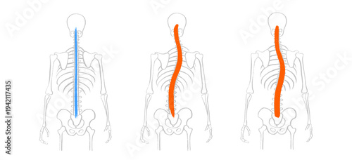 Scoliosis spine deformity