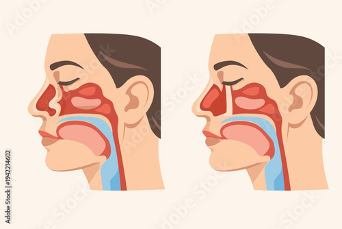 Medical Illustration of a Human Face Cross Section Comparing a Deviated Nasal Septum and a Normal Nasal Septum for Breathing and Airway Health Education, Flat Vector Style Anatomy Diagram