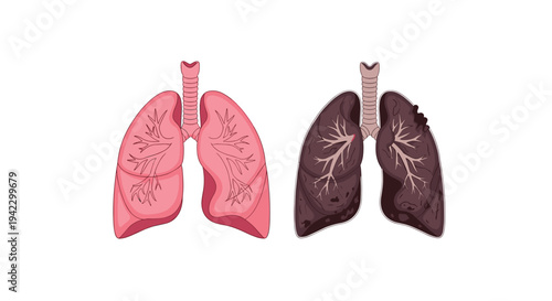 Two illustrated human lung sets, one healthy pink and one diseased dark brown, are displayed side-by-side on a white background.