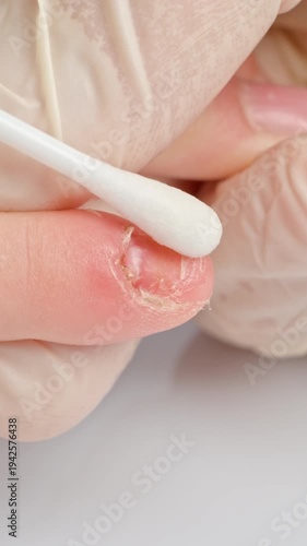 Using cotton swab for damaged nail care close up vertical video
