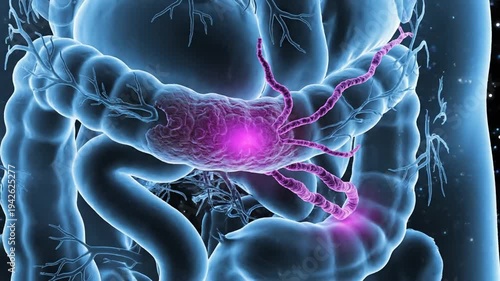 Visualization of colon cancer in the human body, highlighting affected areas and anatomical