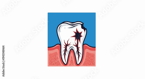 Illustration of a diseased tooth with cavities and exposed nerves