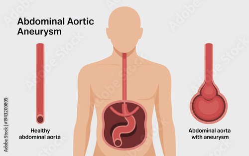 A medical diagram illustrates the difference between a healthy abdominal aorta and an aneurysm condition