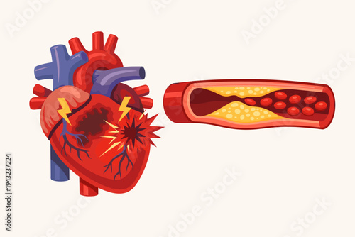 Medical illustration of a heart attack and atherosclerosis showing a damaged human heart with a cross-section of a coronary artery blocked by cholesterol plaque and blood clot formation.
