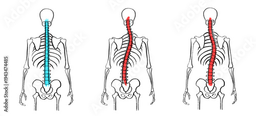 Scoliosis spine deformity