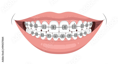 A wide, smiling mouth reveals a full set of perfectly aligned teeth fitted with traditional metal braces.