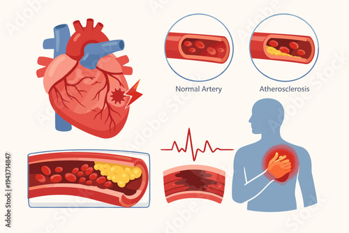 Medical Illustration of Heart Attack Pathology and Atherosclerosis Showing Plaque Buildup in Arteries, Blood Clot Formation, Myocardial Infarction, Chest Pain Symptoms, and ECG Heartbeat Rhythm