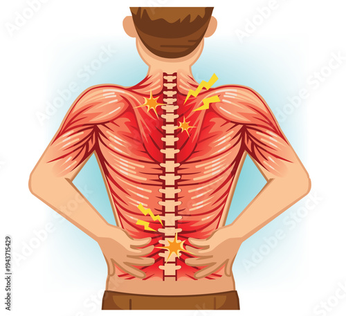 Back Muscle Pain and Spine Inflammation Illustration