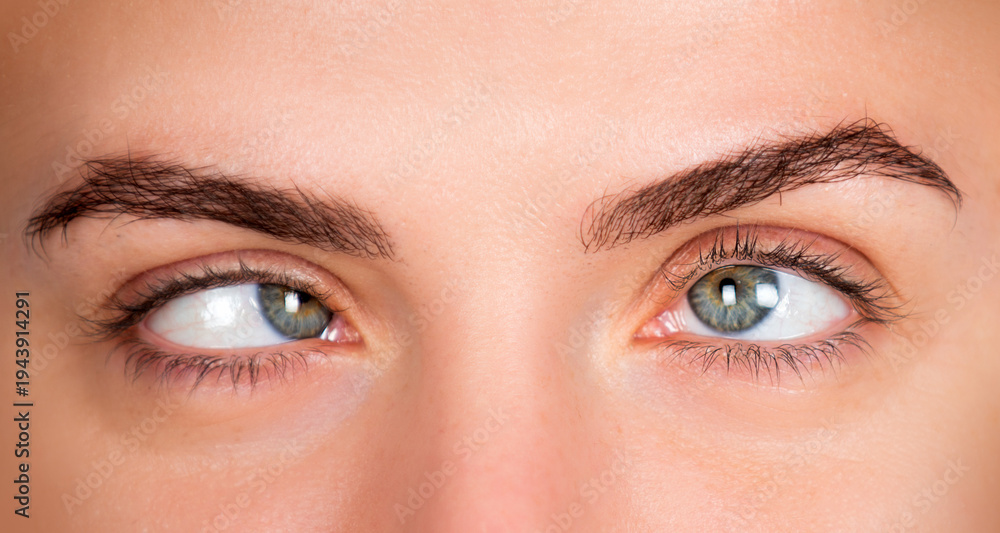 Obraz premium Strabismus human eyes macro detail. Strabismus ophthalmic vision disorder concept. Strabismus female facial expression closeup. Strabismus sideways eye look.