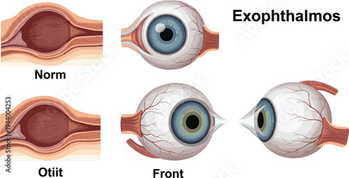 Vector illustration of human eye anatomy showing normal, inflamed, and exophthalmos conditions for medical, educational, and scientific artwork