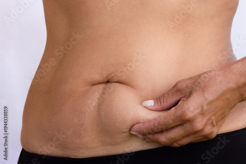 Cuadro en lienzo Side view of a woman gently pressing loose skin and stretch marks on her lower a