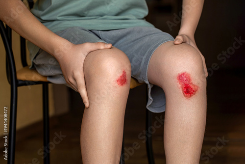 Slika na platnu Bruised wound injury on woman knee background