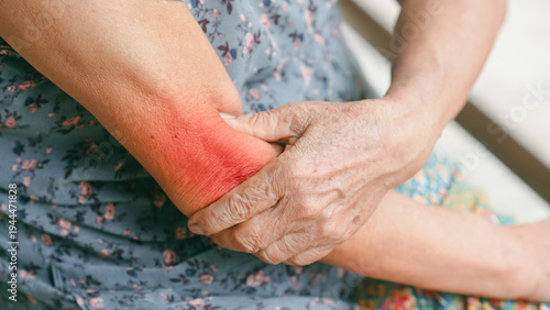 Close up of senior woman holding painful elbow with red inflammation area, symbolizing arthritis, joint inflammation or tendonitis. Elderly healthcare and chronic pain management concept.