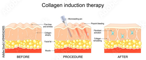 Collagen induction therapy. Before and After Microneedling procedure.