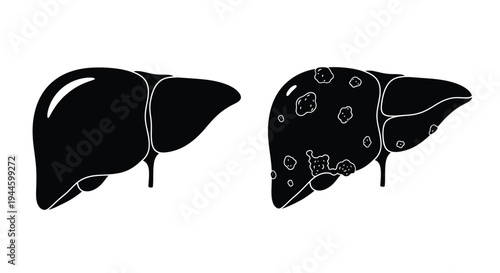 Illustration of a healthy liver compared to a liver with lesions