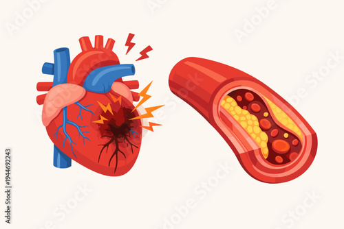 Medical Illustration of a Heart Attack and Atherosclerosis Showing a Damaged Human Heart with Necrotic Tissue and a Cross Section of a Coronary Artery Blocked by Cholesterol Plaque Buildup