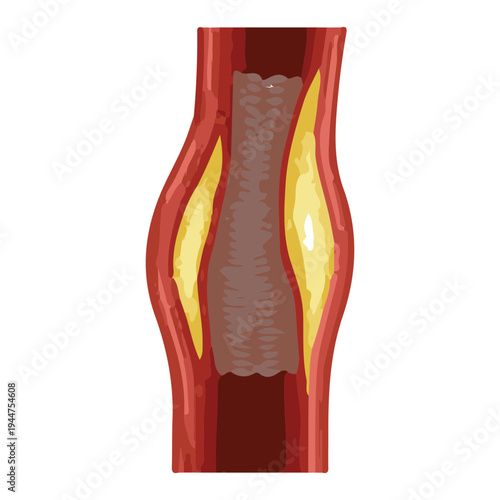 Artery Plaque Buildup Illustration
