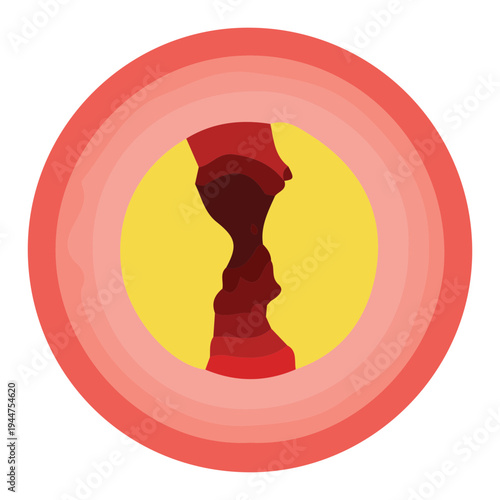 Artery Blockage Illustration