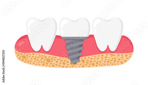 Dental implant with post and crown. Dental prosthetics and restoration concept. Vector illustration