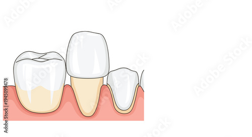 Medical illustration showing different types of dental crowns and tooth implants placed in healthy pink gums for restorative dentistry.