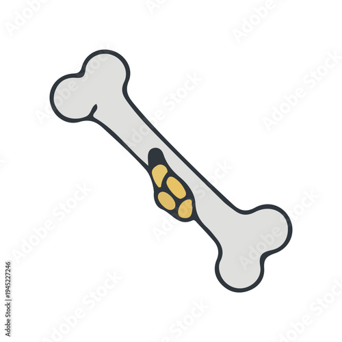 Bone Tumor Illustration