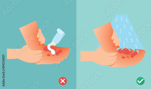 wrong and right skin burn first aid