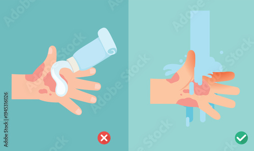 wrong and right skin burn first aid