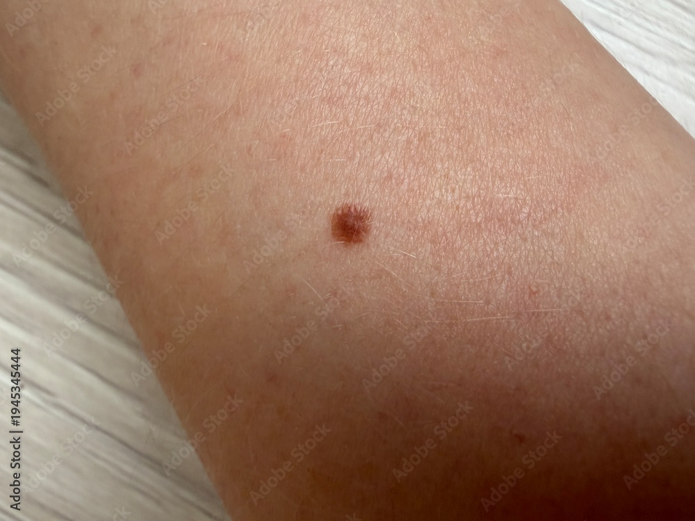 Fototapeta premium Brown nevus on the skin of a human arm. Close up view of a mole on the body. Medical dermatology concept for mole check, skin cancer screening and health examination of epidermis.