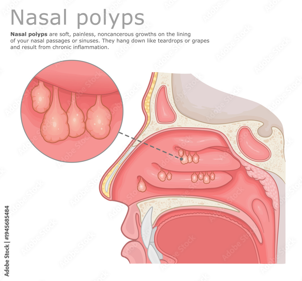 Obraz premium Anatomical diagram of nasal polyps with close-up view of growths in the nose. Vector illustration. ENT Series.