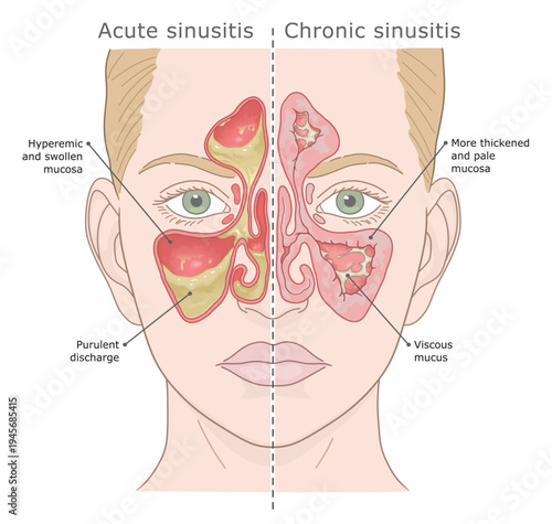 Medical illustration comparing acute and chronic sinusitis symptoms in a female face. Vector illustration. ENT Series.