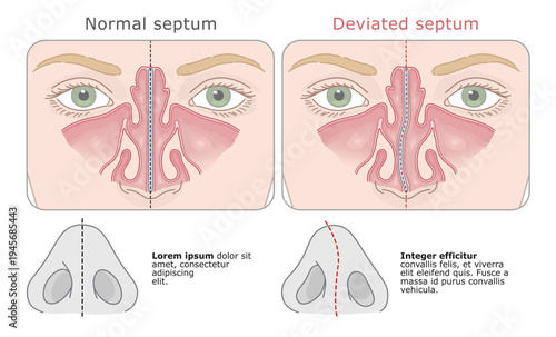 Anatomical comparison of a straight and deviated nasal septum in human nose. Vector illustration. ENT Series.