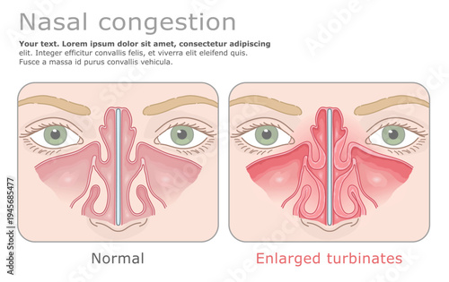 Anatomical comparison of normal nasal cavity and hypertrophied nasal turbinates. Vector illustration. ENT Series.