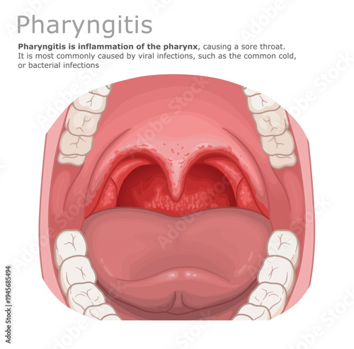 Medical vector illustration of pharyngitis, showing an open mouth with an inflamed and reddened throat. ENT Series.