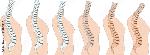 Human Spine Posture Comparison Illustration Showing Healthy Back Alignment and Spinal Curvature Conditions Medical Diagram