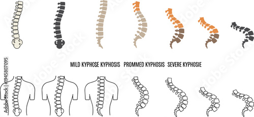 Human Spine Alignment and Posture Illustration Set Showing Healthy Back Curve and Spinal Deformation Medical Education Diagram