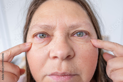 Photos female eye with visible redness, severe swelling, Clinical observation periorbit