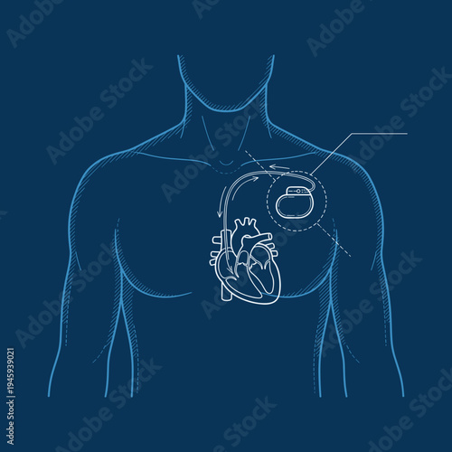 Pacemaker implantation concept showing cardiac device connected to heart for rhythm control and cardiovascular treatment.