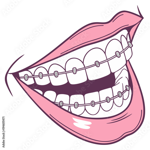 A false jaw, or dental prosthetic, replaces missing teeth, restoring function and appearance, crafted to fit comfortably and support natural chewing and smiling.