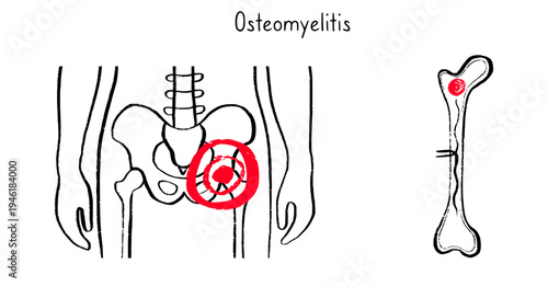 Osteomyelitis disease sketch