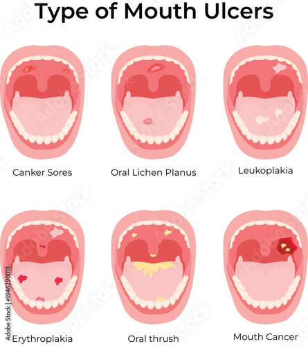 Types of Mouth Ulcers Medical Infographic Vector Illustration