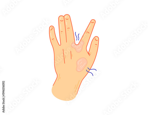 Illustration of a hand with a red rash. The skin on the hand is infected with a fungus, eczema, dermatitis, ringworm, or athlete's foot. Skin diseases and health problems. Flat style illustration 