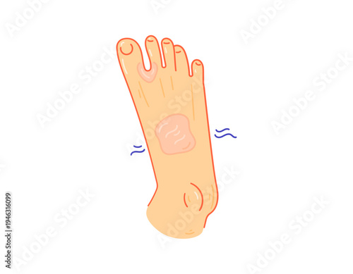Illustration of feet with a red rash. The skin on the feet is affected by a fungal infection, eczema, dermatitis, ringworm, or athlete's foot. Skin diseases and health problems. Flat style 