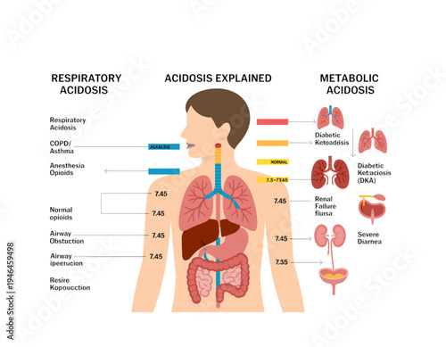 A detailed illustration of the human body explaining acidosis, including respiratory and metabolic acidosis, on transparent background