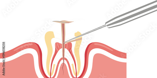 Dental Root Canal Treatment Procedure Vector Illustration Showing Tooth Anatomy, Nerve Removal with Dental Tools and Endodontic Therapy for Dentistry Education and Healthcare Design