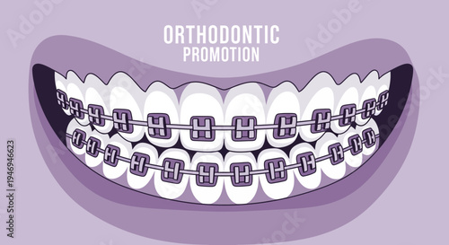 Orthodontic Treatment Promotion: A Cartoon Illustration of Braces on a Smiling Mouth