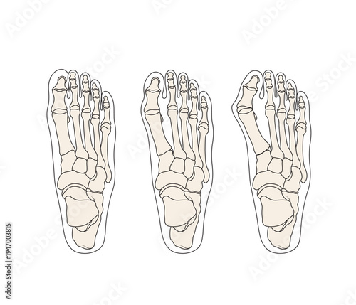 Human foot skeleton anatomy showing hallux valgus bunion progression, medical orthopedic diagram set